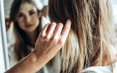 Recent Advances in Treating Psoriasis and Eczema: New Hope for Patients